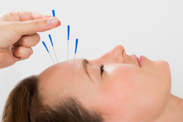 Headaches Acupuncture Middle Tennessee