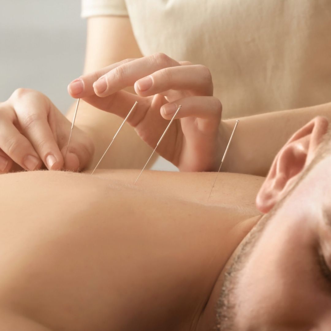 Acupuncture treatment