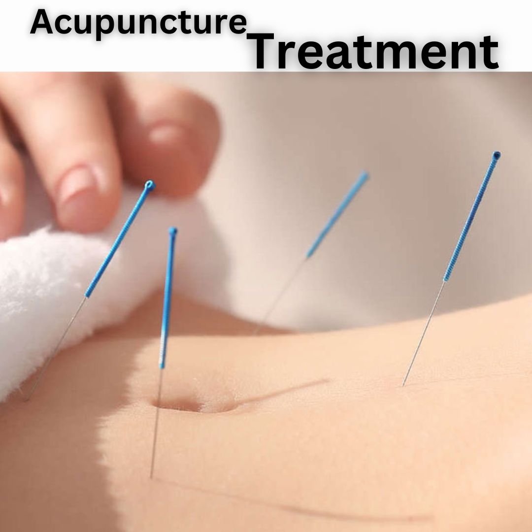 acupuncture