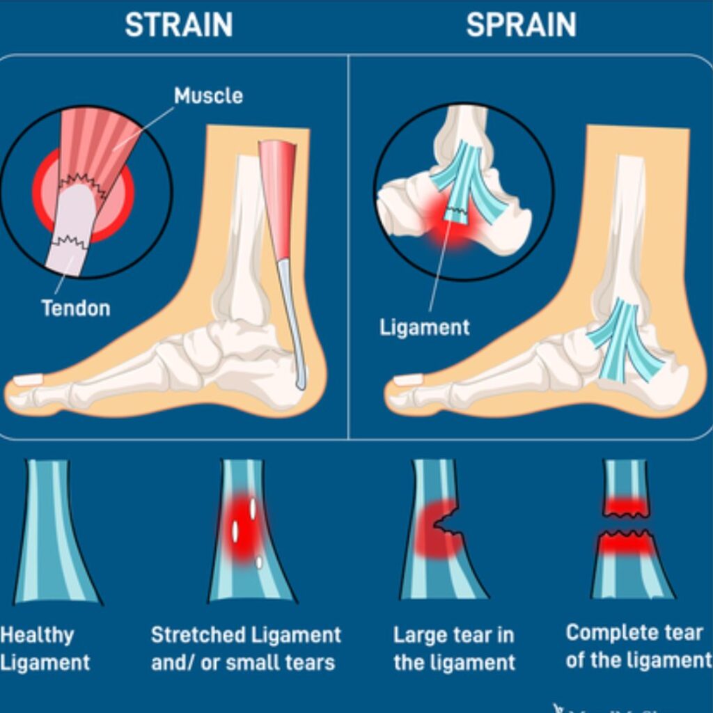 sprain and strain treatment