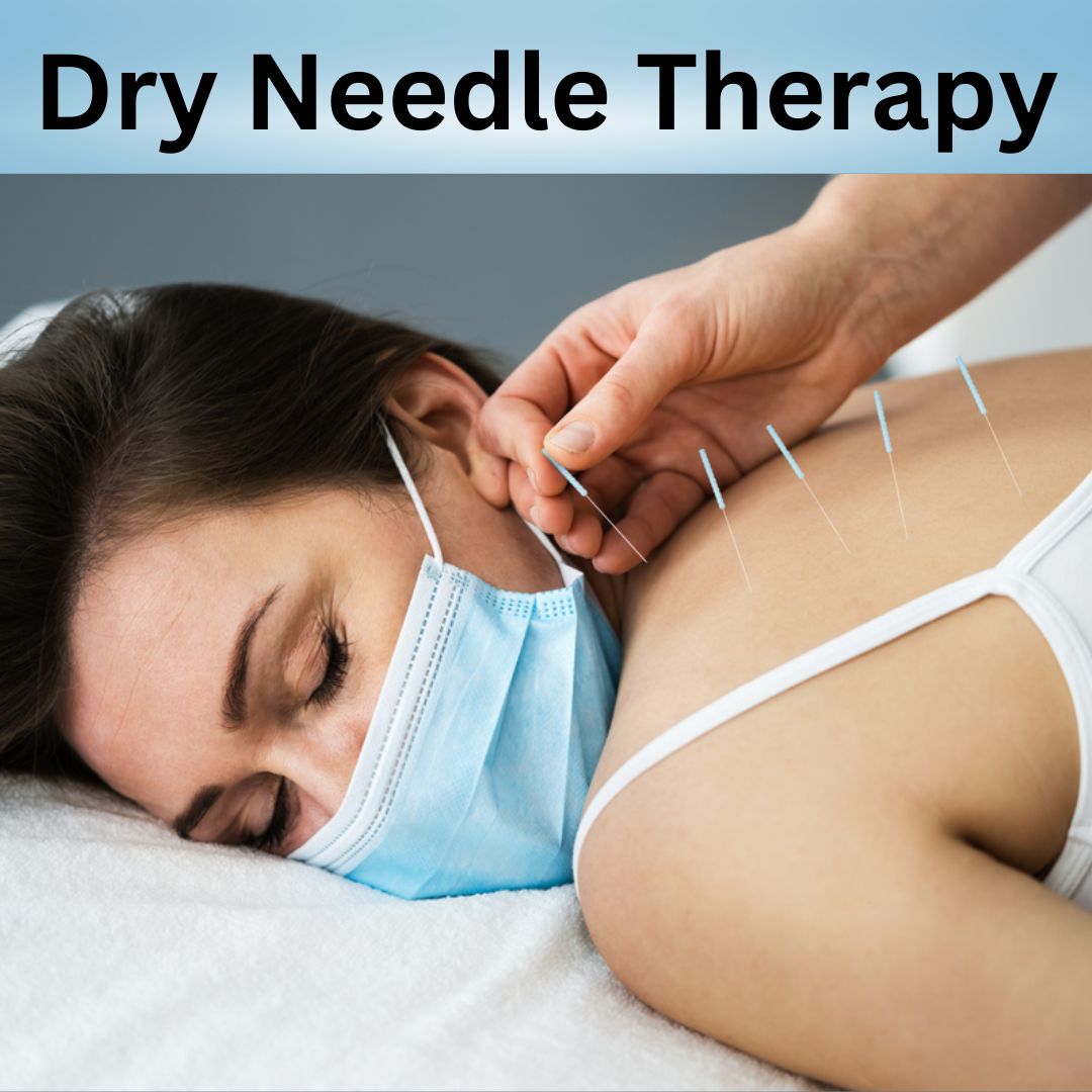 dry needle therapy