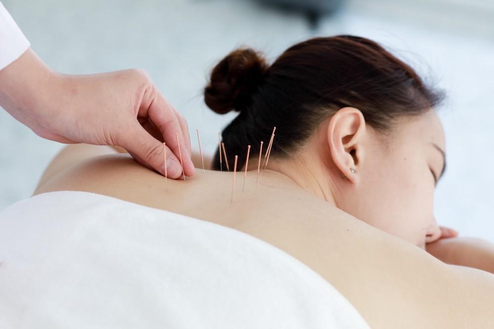 Acupuncture Treatment