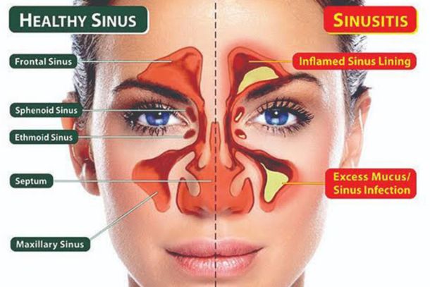 Non-Surgical Endo-Nasal Treatment