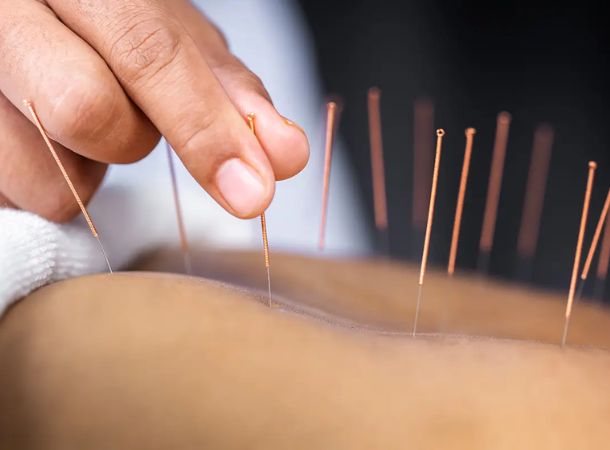 acupuncture treatment