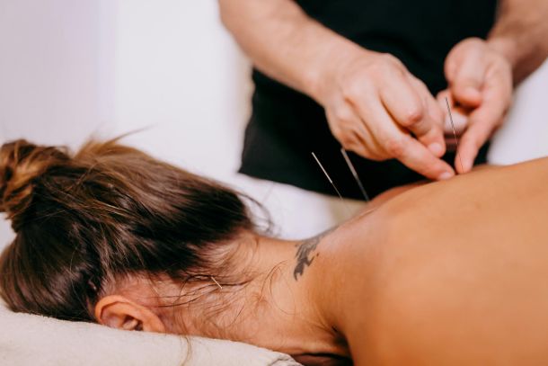 Acupuncture Dry Needle Treatment