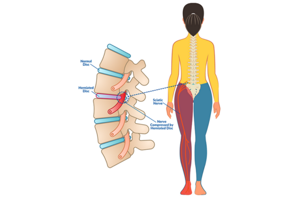 Low Back Disc Injury Middle Tennessee