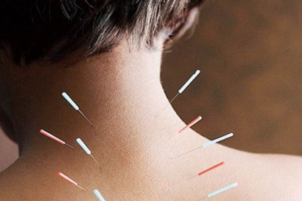 Acupuncture Dry Needle Treatment