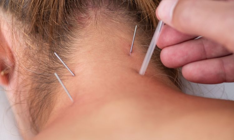 Dry Needle Treatment Tennessee
