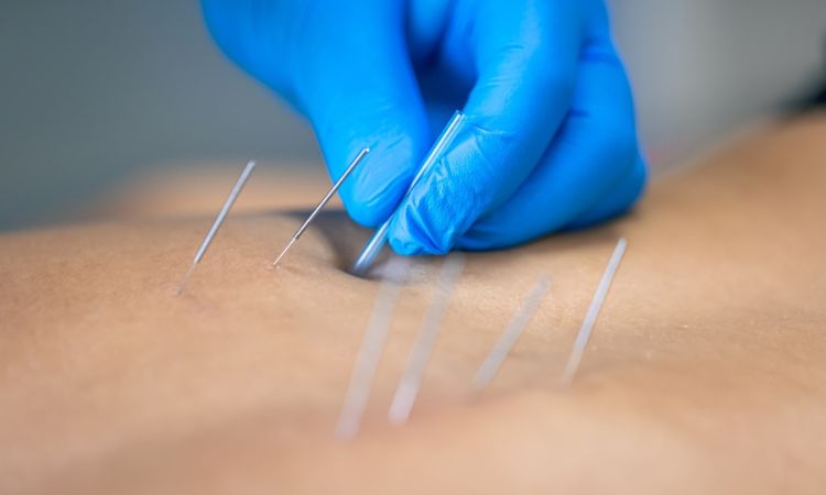 Acupuncture Dry Needle Treatment Tennessee