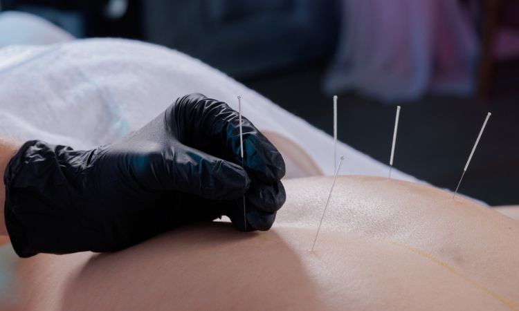 Acupuncture Dry Needle Treatment Tennessee